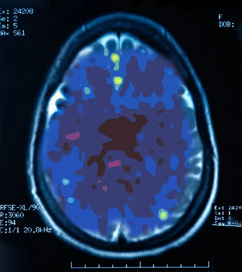 PET scan of a depressed brain showing reduced activity