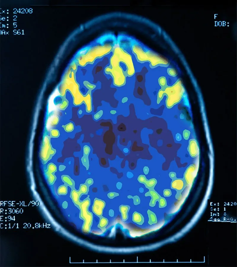 PET scan of a non-depressed brain showing widespread activity